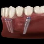 Benefits of All-on-4 Dental Implants