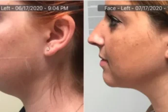 Chisel Your Jawline: A 4-Week Journey to Double Chin Elimination with Agnes RF