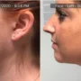 Chisel Your Jawline: A 4-Week Journey to Double Chin Elimination with Agnes RF