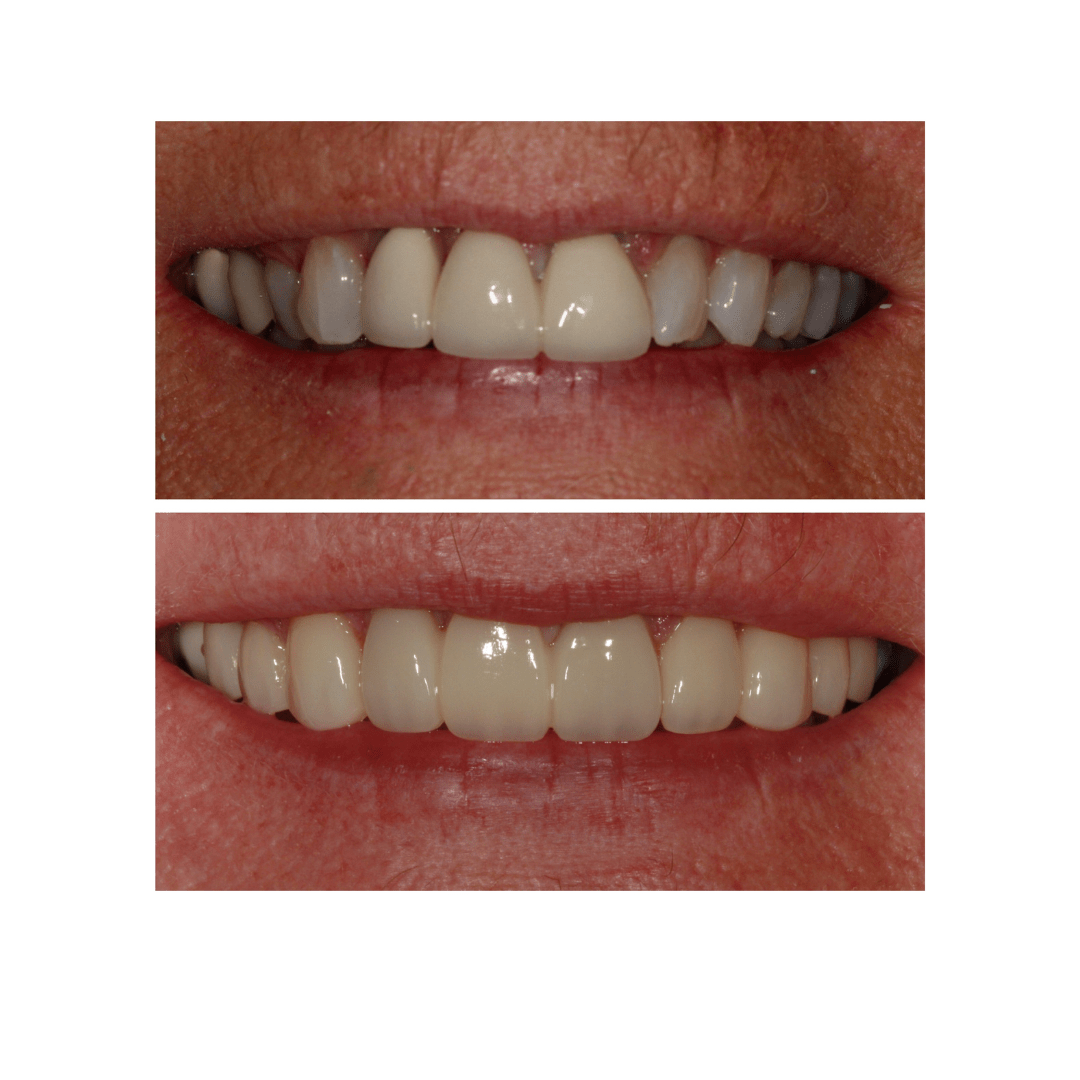 Dental Veneers